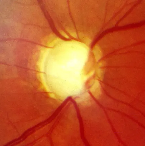 color fundus image of the optic disc, diagnosis hidden