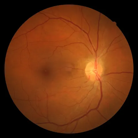color fundus image of a left eye, diagnosis hidden