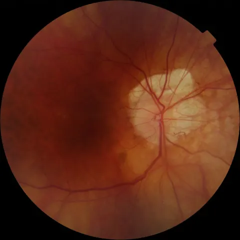 color fundus image of a right eye, diagnosis hidden