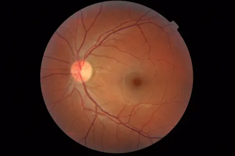 color fundus image, diagnosis hidden