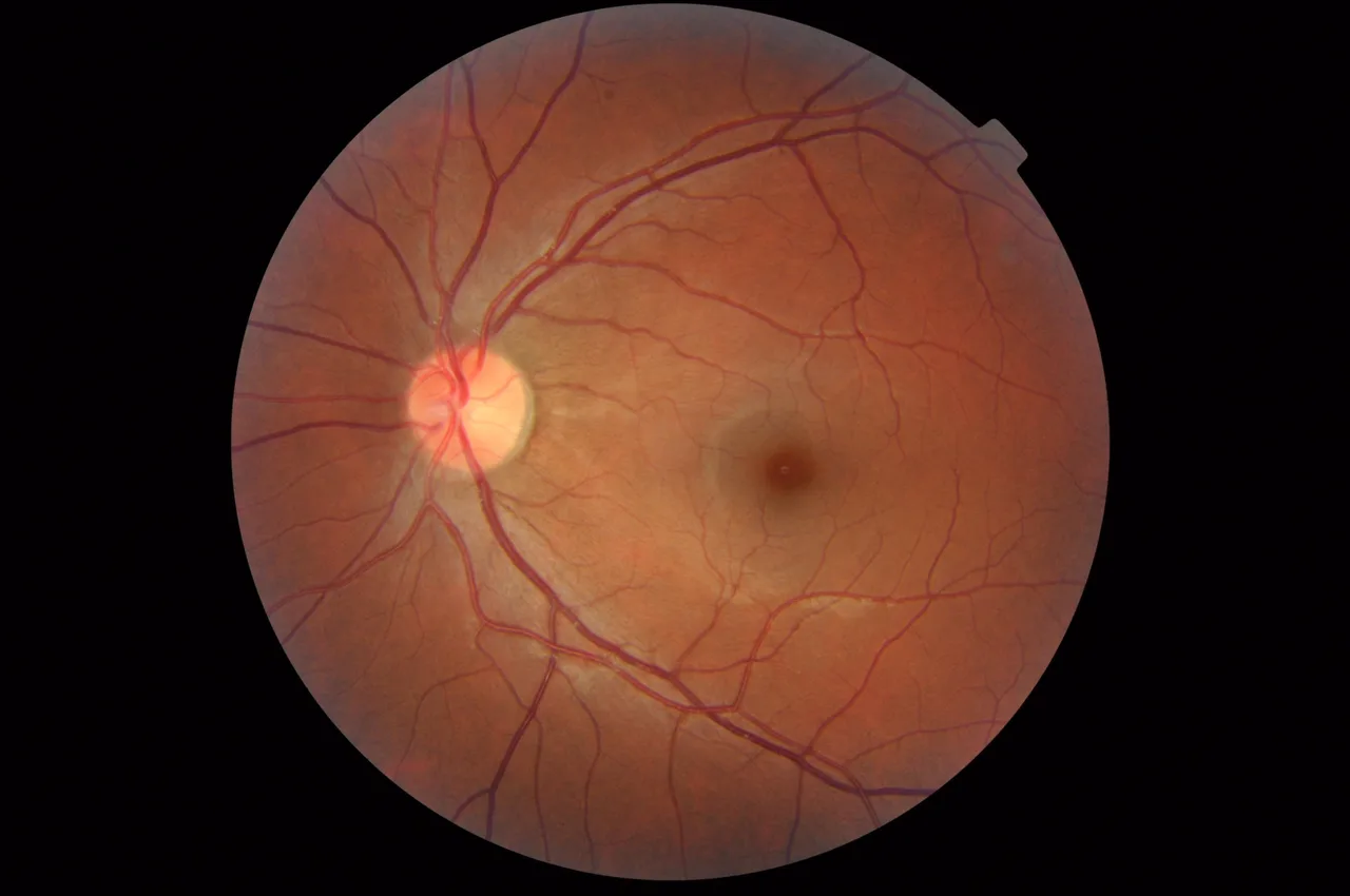 color fundus image, diagnosis hidden