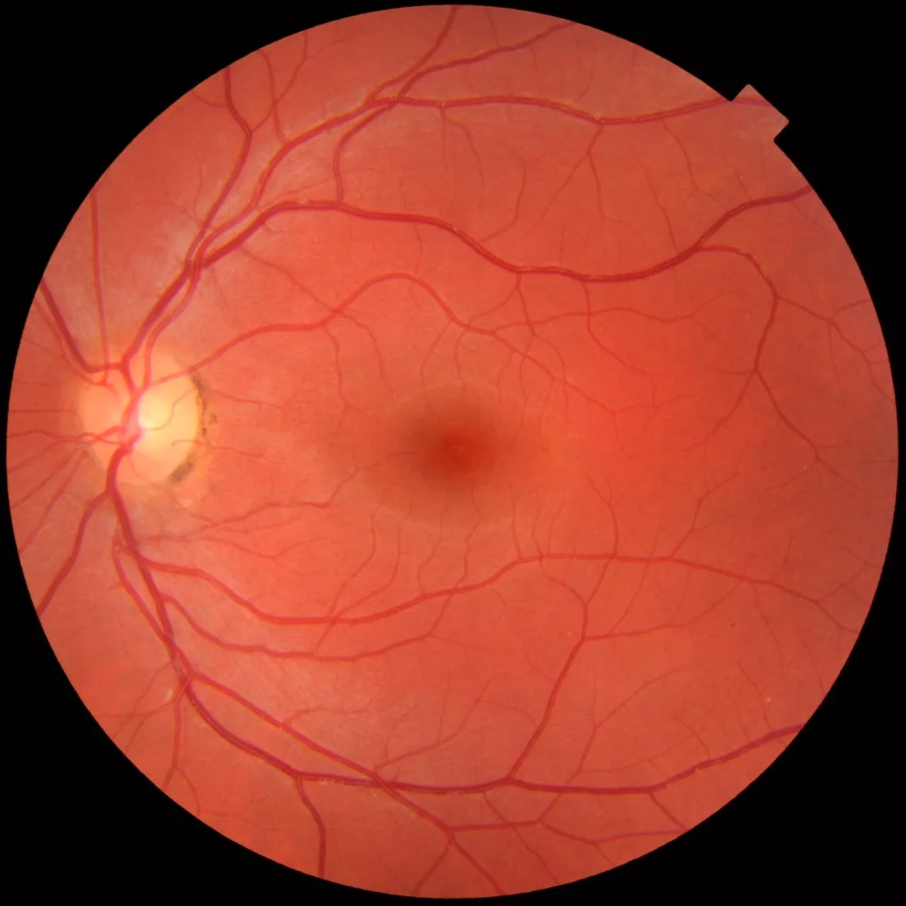 color fundus image, diagnosis hidden