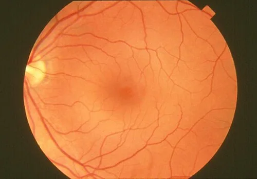 color fundus image, diagnosis hidden