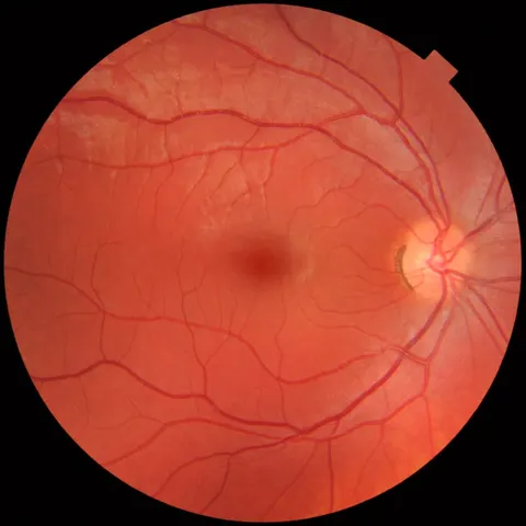 color fundus image, diagnosis hidden