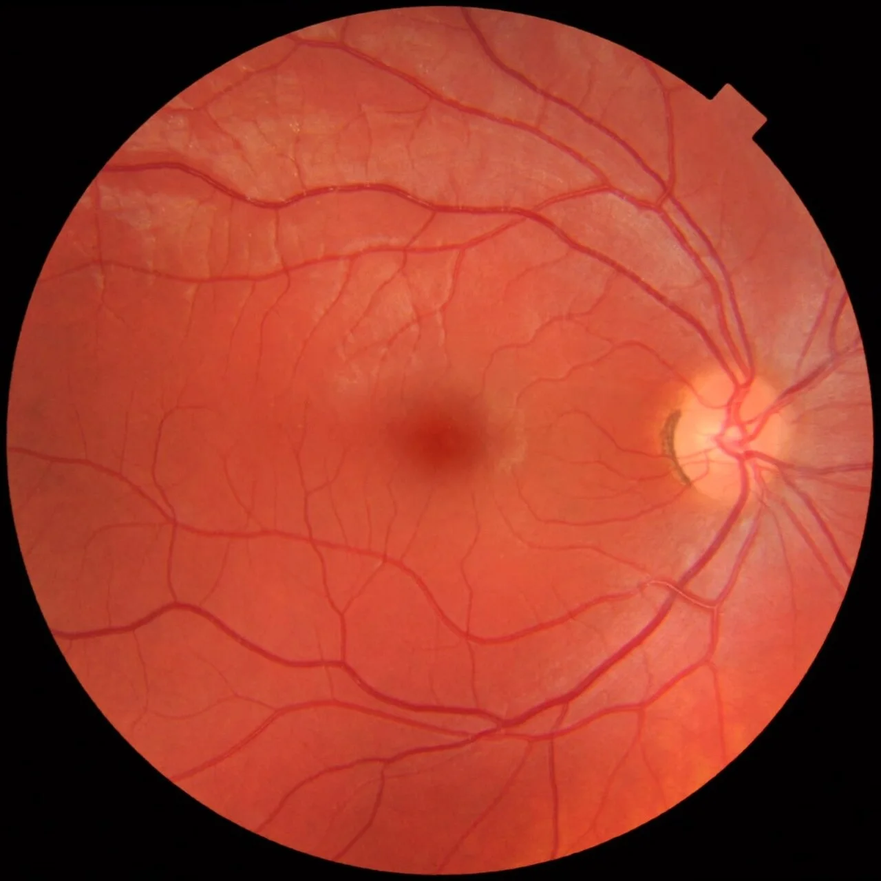 color fundus image, diagnosis hidden