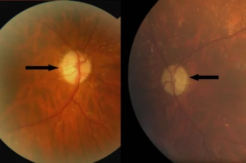 color fundus study, the diagnosis is hidden until you answer