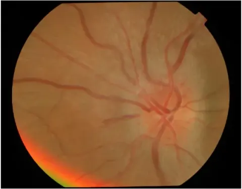 color fundus image of a right eye, diagnosis hidden