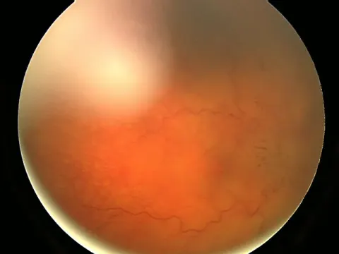 color fundus image of a right eye, diagnosis hidden