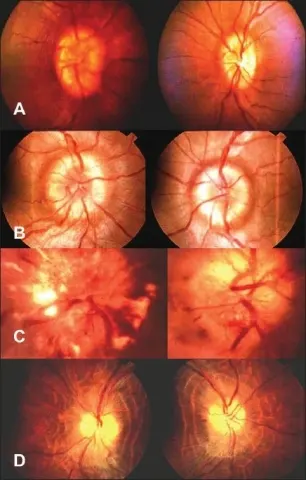 a four-panel figure of optic disc photographs labelled A to D