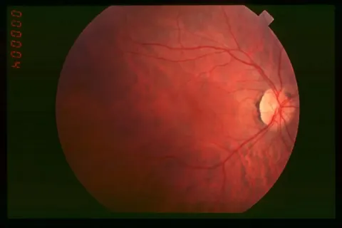 color fundus image, diagnosis hidden