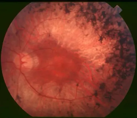 color fundus image, diagnosis hidden