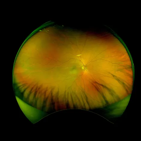 color fundus image, diagnosis hidden