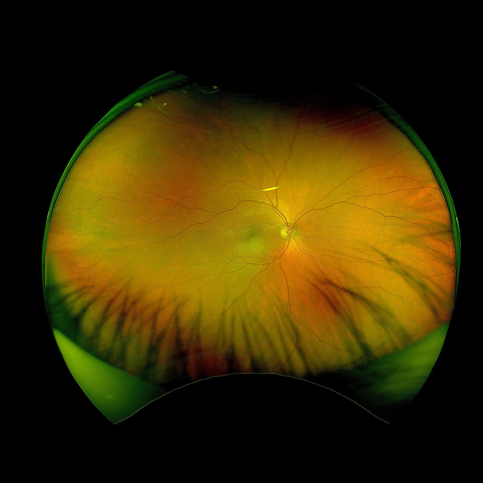 color fundus study, the diagnosis is hidden until you answer
