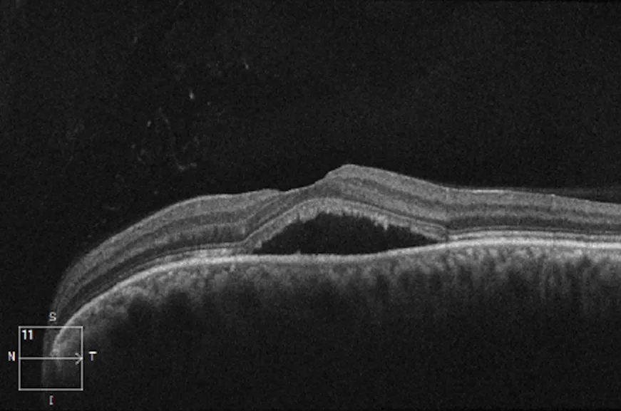 OCT macula cross-section, diagnosis hidden