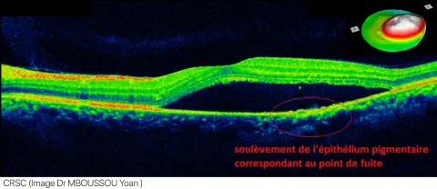 an annotated OCT macula image with labels