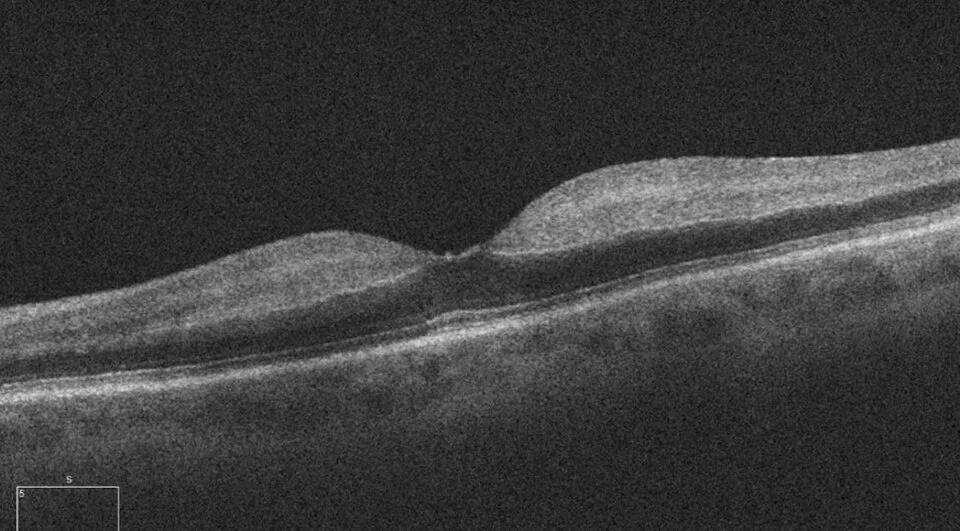 oct macula image, diagnosis hidden