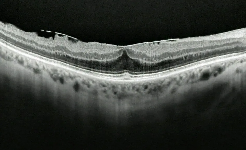 OCT macula cross-section, diagnosis hidden