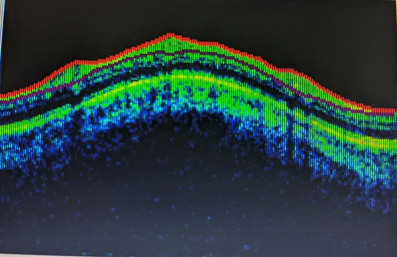 OCT macula cross-section in colour scale, diagnosis hidden