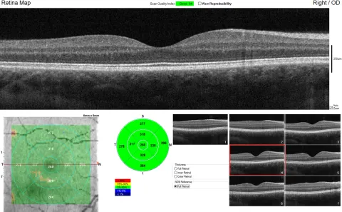 a macular OCT report page with a cross-section, thickness map and sector values