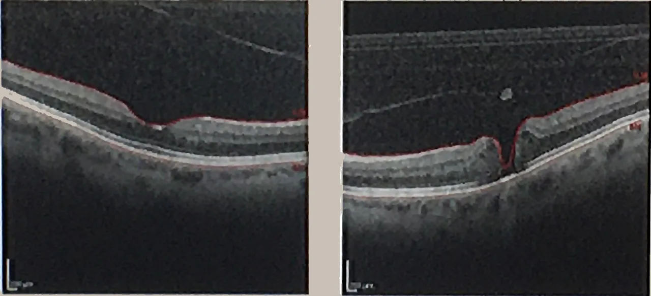 two OCT macula cross-sections side by side, diagnosis hidden