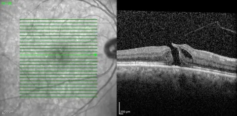 an infrared en face image with scan lines and an OCT cross-section, diagnosis hidden