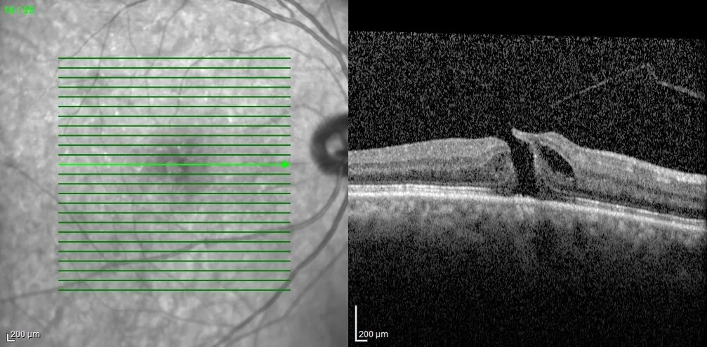 an infrared en face image with scan lines and an OCT cross-section, diagnosis hidden