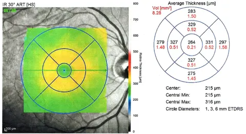 oct macula image, diagnosis hidden