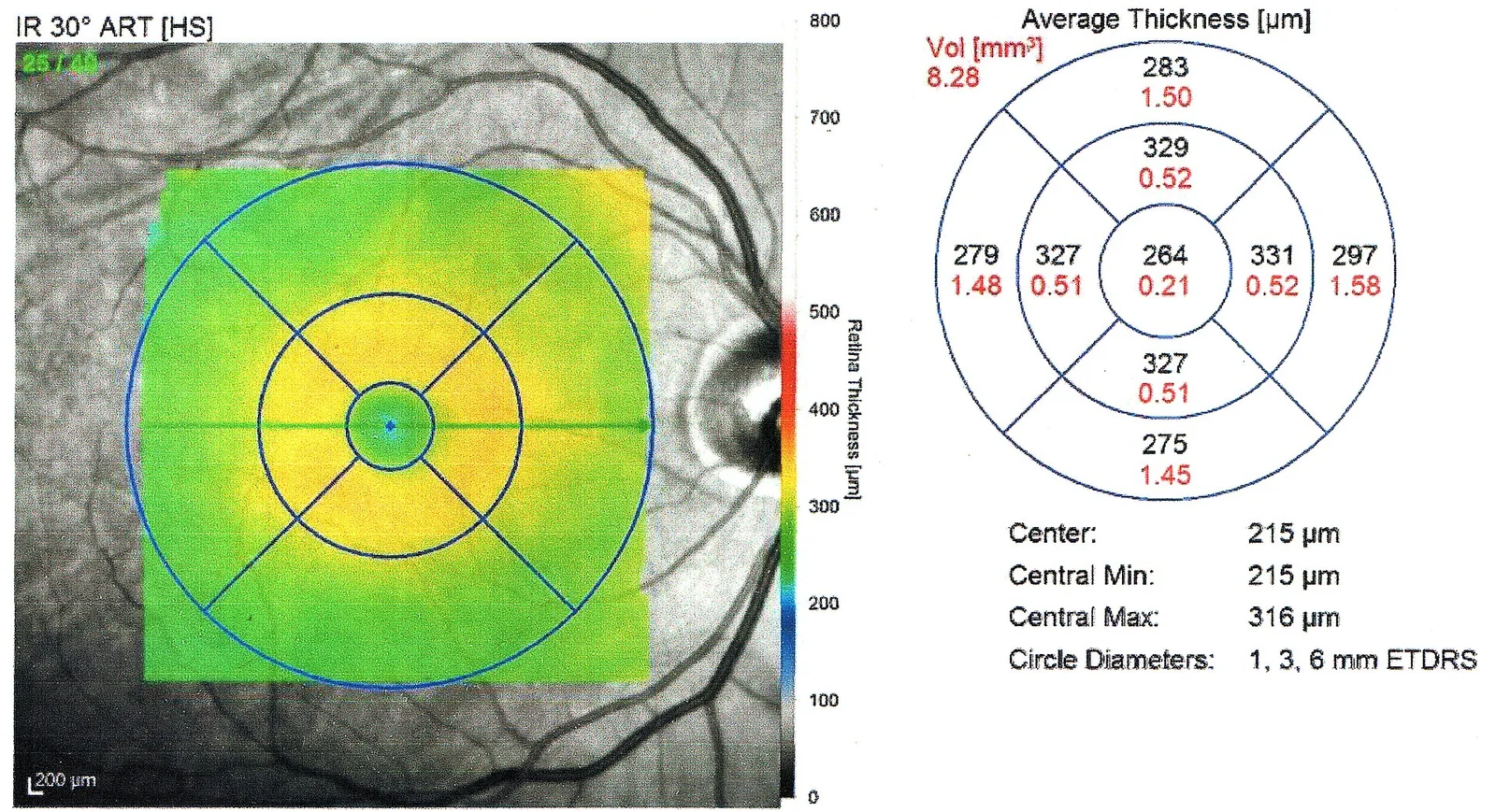 oct macula image, diagnosis hidden