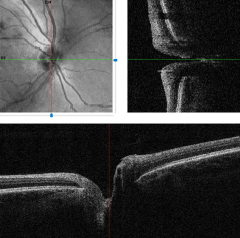 oct optic nerve image, diagnosis hidden
