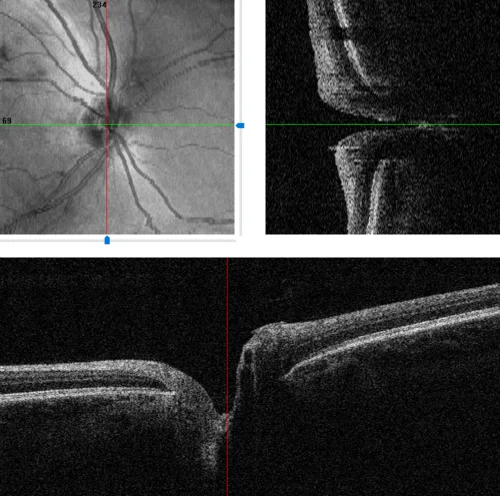 oct optic nerve study, the diagnosis is hidden until you answer