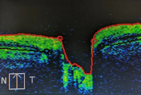 OCT cross-section through the optic nerve head in colour scale