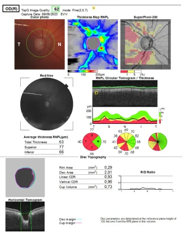 an optic nerve head imaging report printout