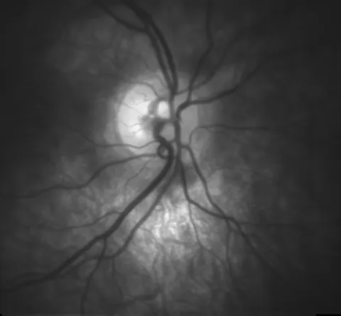 red free fundus image, diagnosis hidden