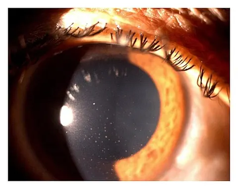 slit lamp image, diagnosis hidden