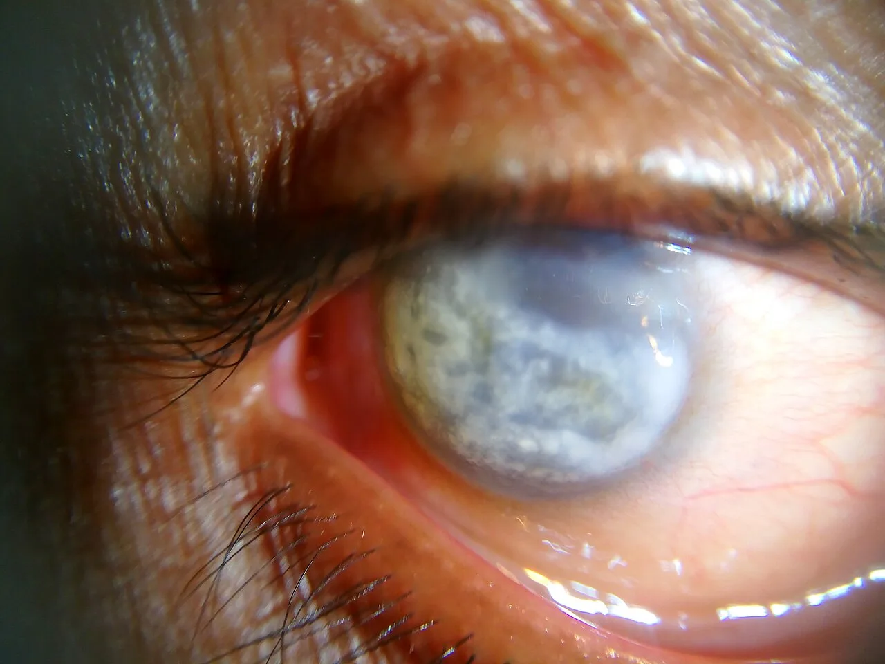 external close-up photograph of an eye, diagnosis hidden