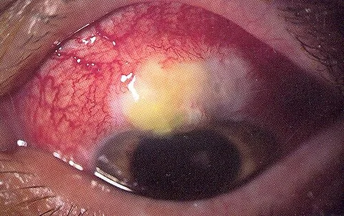 slit lamp study, the diagnosis is hidden until you answer