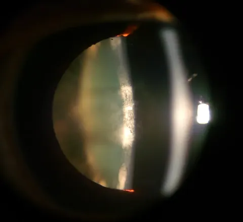 slit lamp photograph of the lens, diagnosis hidden