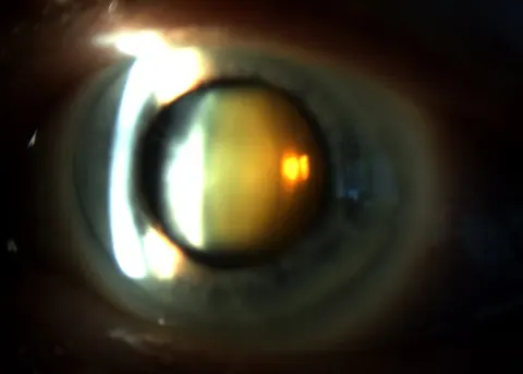 slit lamp photograph of the lens, diagnosis hidden