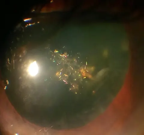 slit lamp photograph of the lens, diagnosis hidden