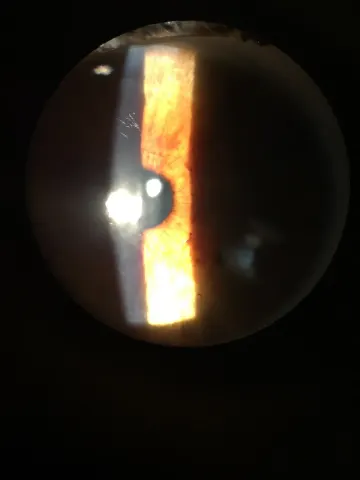 slit lamp photograph of the lens, diagnosis hidden