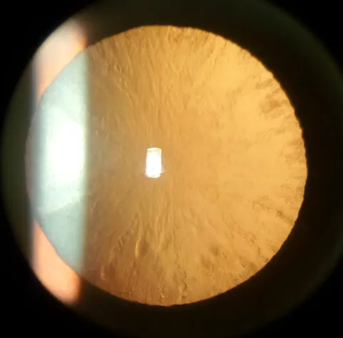 slit lamp retroillumination photograph of the lens, diagnosis hidden