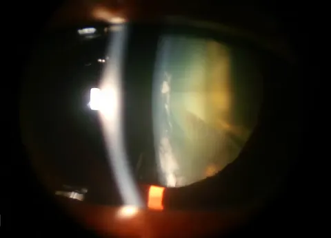 slit lamp photograph of the lens, diagnosis hidden