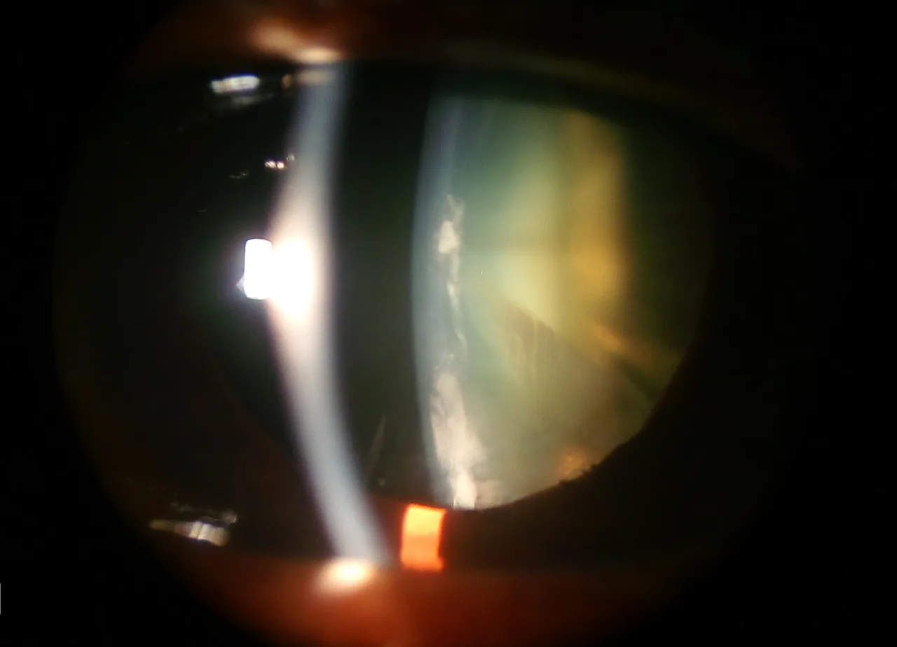 slit lamp photograph of the lens, diagnosis hidden
