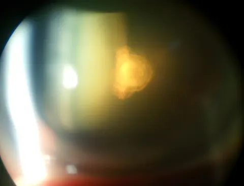 slit lamp optical section of the lens, diagnosis hidden