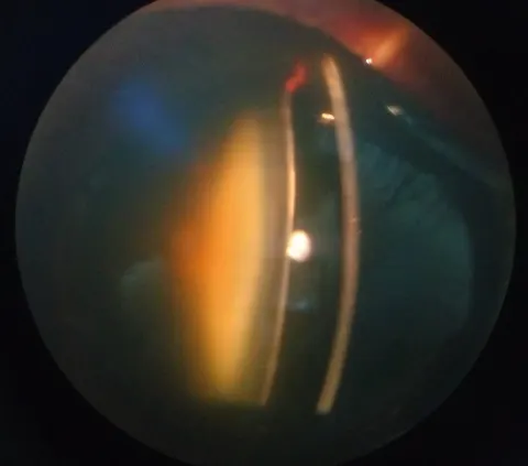 slit lamp optical section of the lens, diagnosis hidden