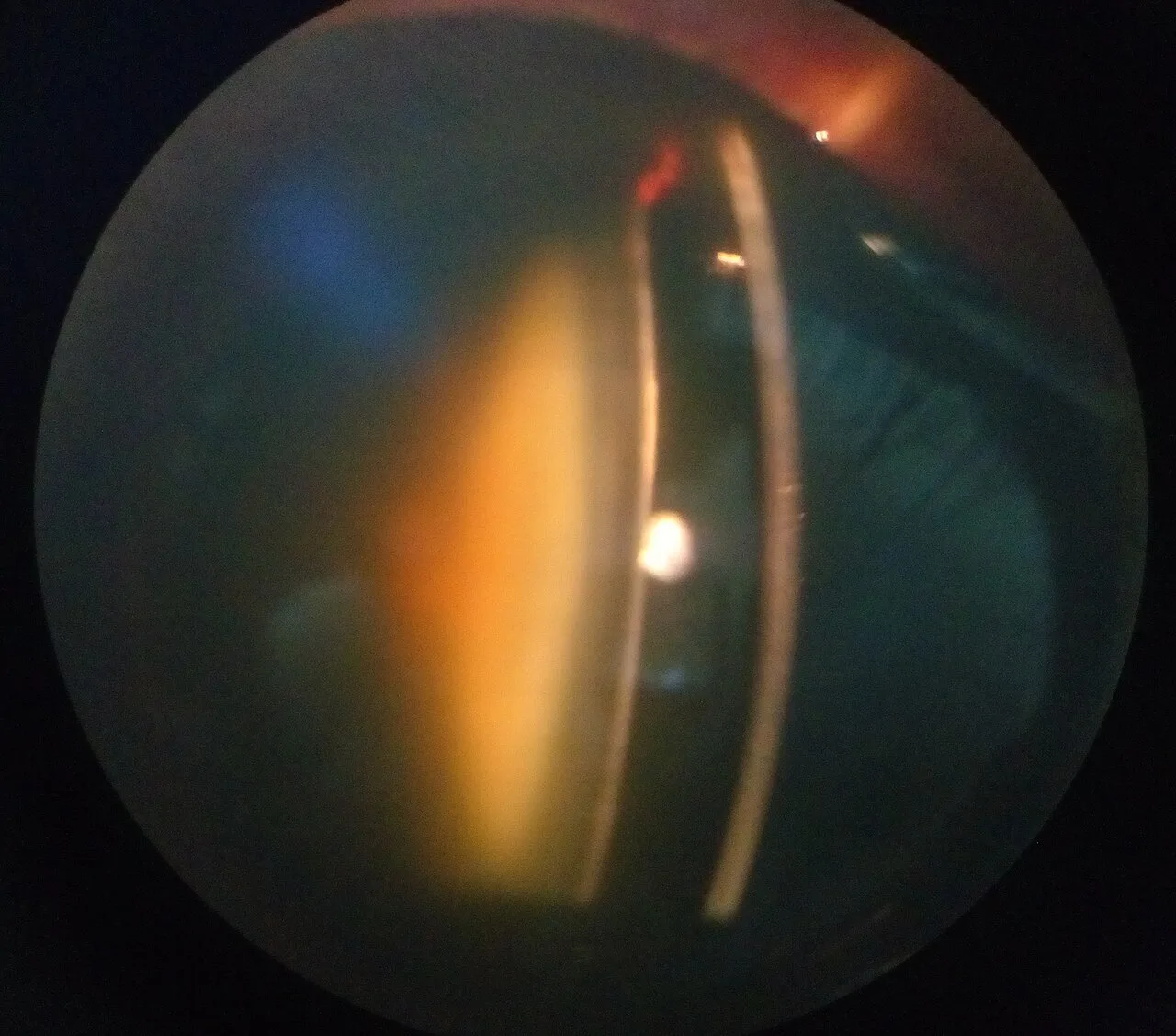 slit lamp optical section of the lens, diagnosis hidden