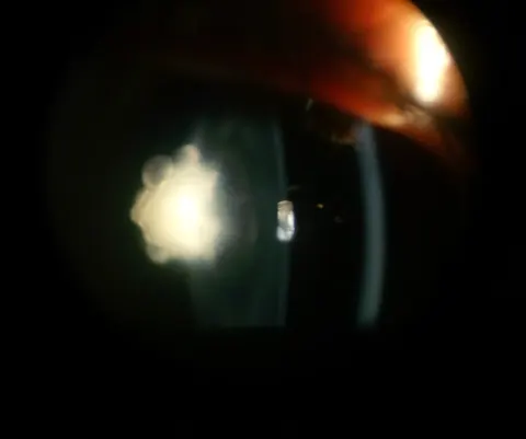 slit lamp photograph of the lens, diagnosis hidden