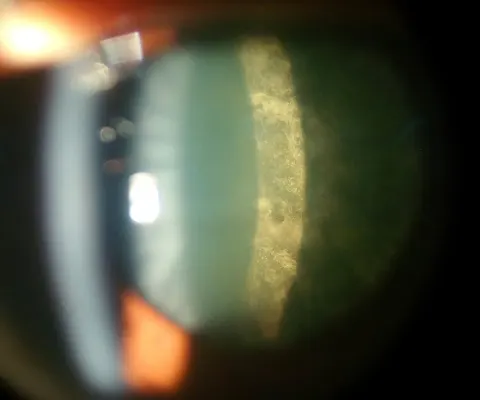 slit lamp photograph of the lens, diagnosis hidden