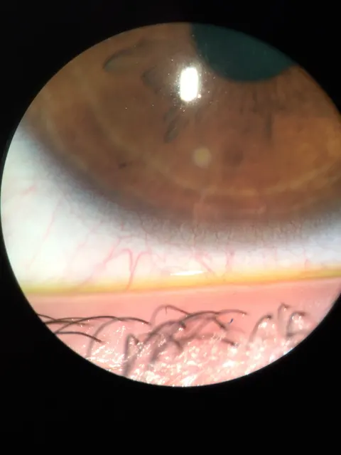 slit lamp image, diagnosis hidden