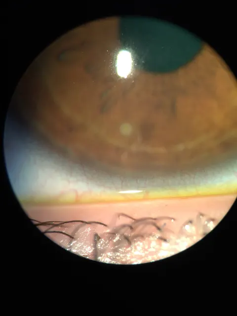slit lamp image, diagnosis hidden